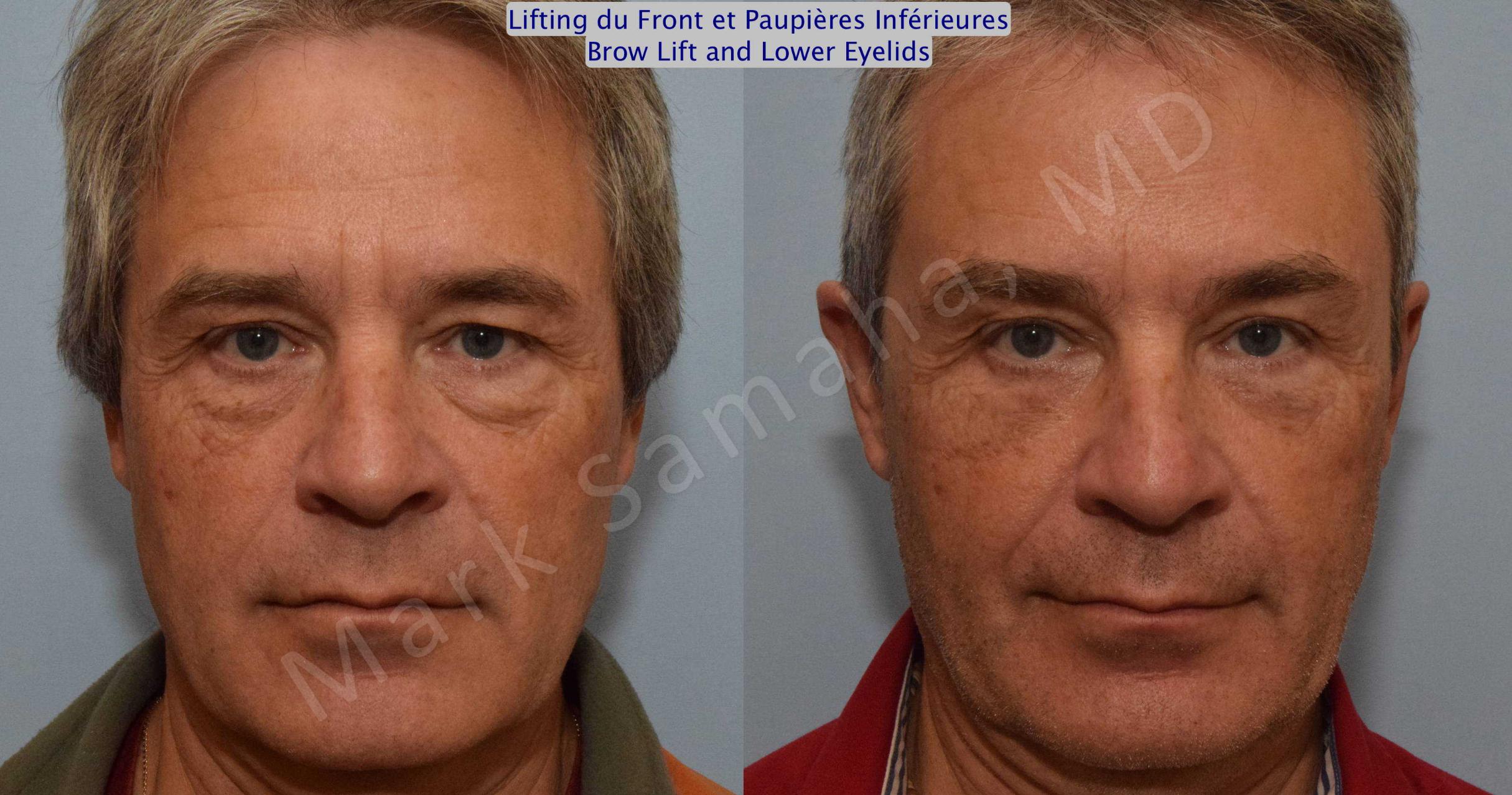 Before & After Blepharoplasty / Blépharoplastie Case 117 View #1 View in Mount Royal, QC