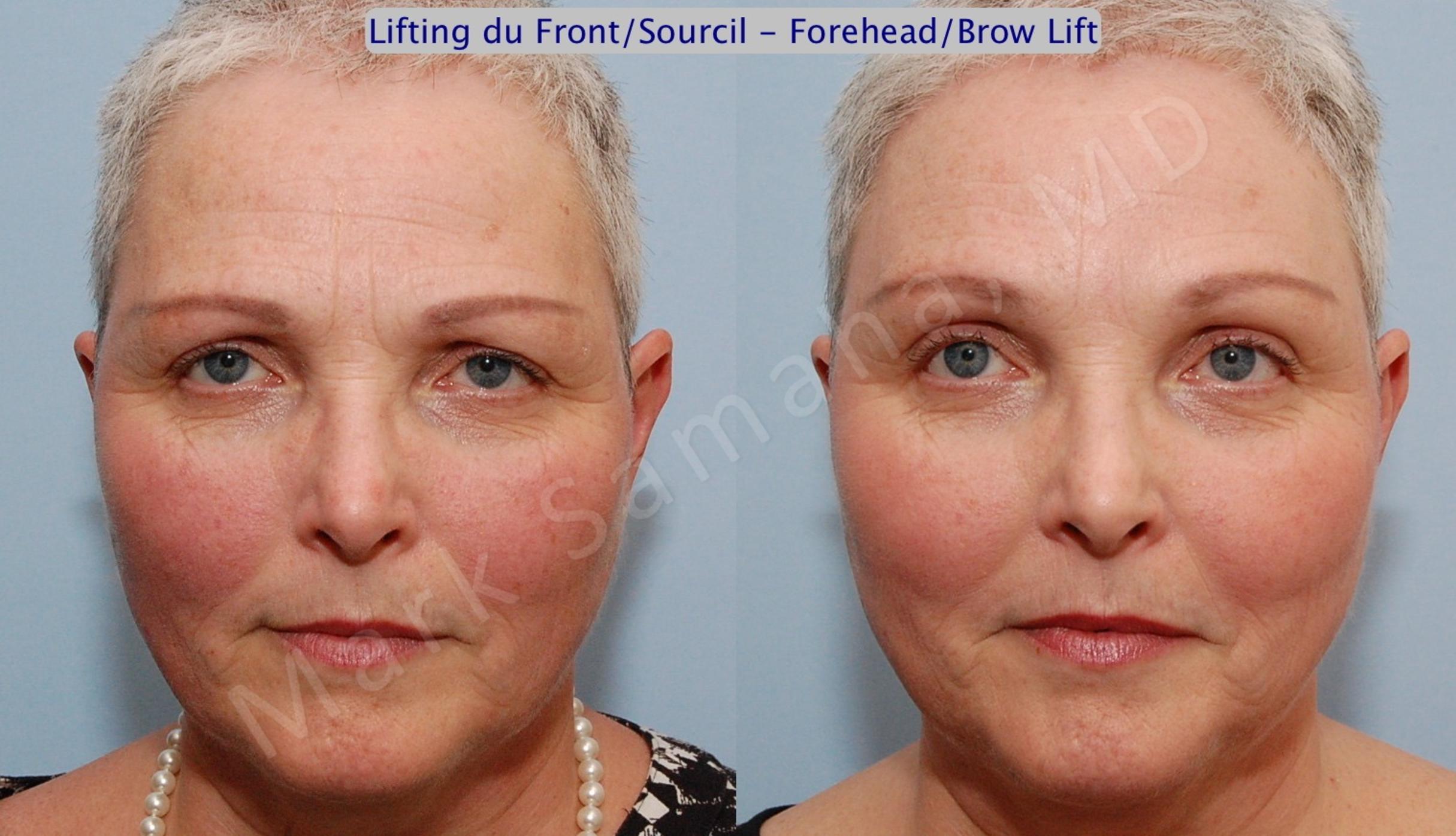 Before & After Brow lift / Lifting du Sourcil Case 87 View #1 View in Mount Royal, QC