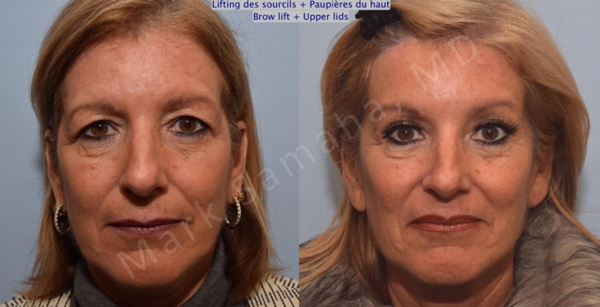 Before & After Blépharoplastie / Blepharoplasty Case 90 View #1 View in Mount Royal, QC