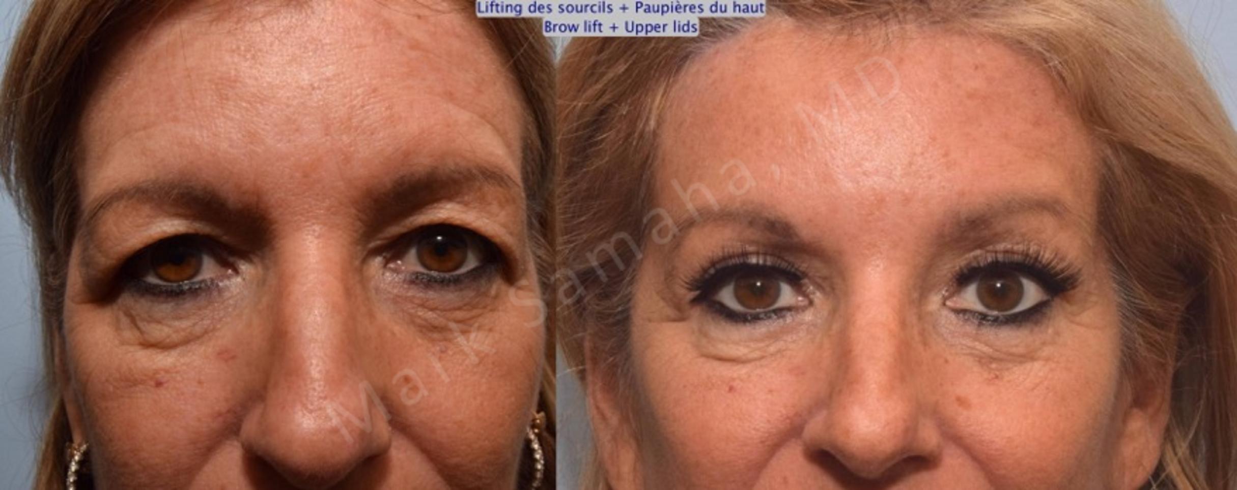 Before & After Blepharoplasty / Blépharoplastie Case 90 View #2 View in Mount Royal, QC