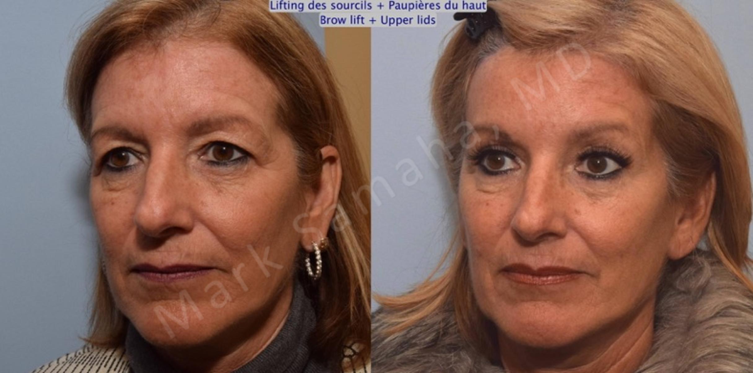 Before & After Brow lift / Lifting du Sourcil Case 90 View #3 View in Mount Royal, QC