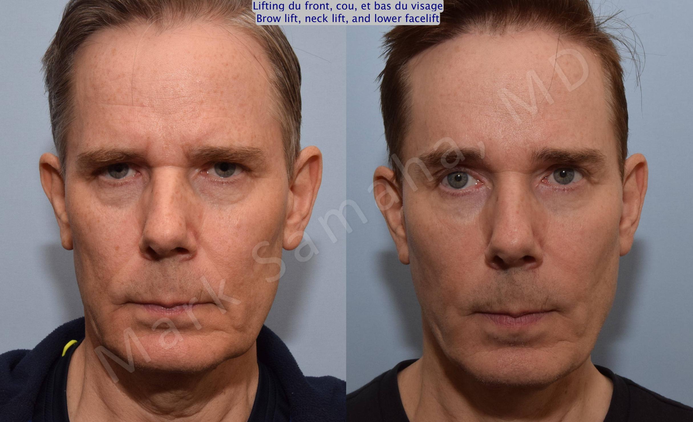 Before & After Brow lift / Lifting du Sourcil Case 91 View #1 View in Mount Royal, QC