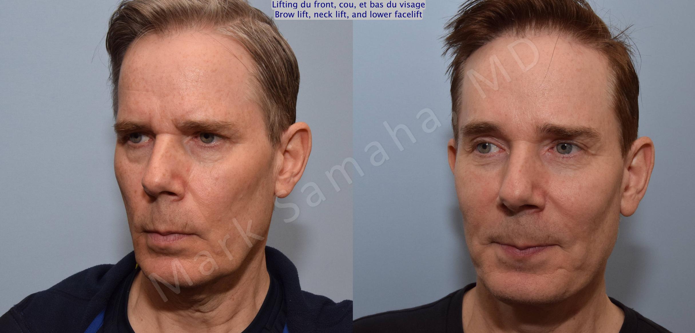 Before & After Lifting du Sourcil / Brow lift Case 91 View #4 View in Mount Royal, QC