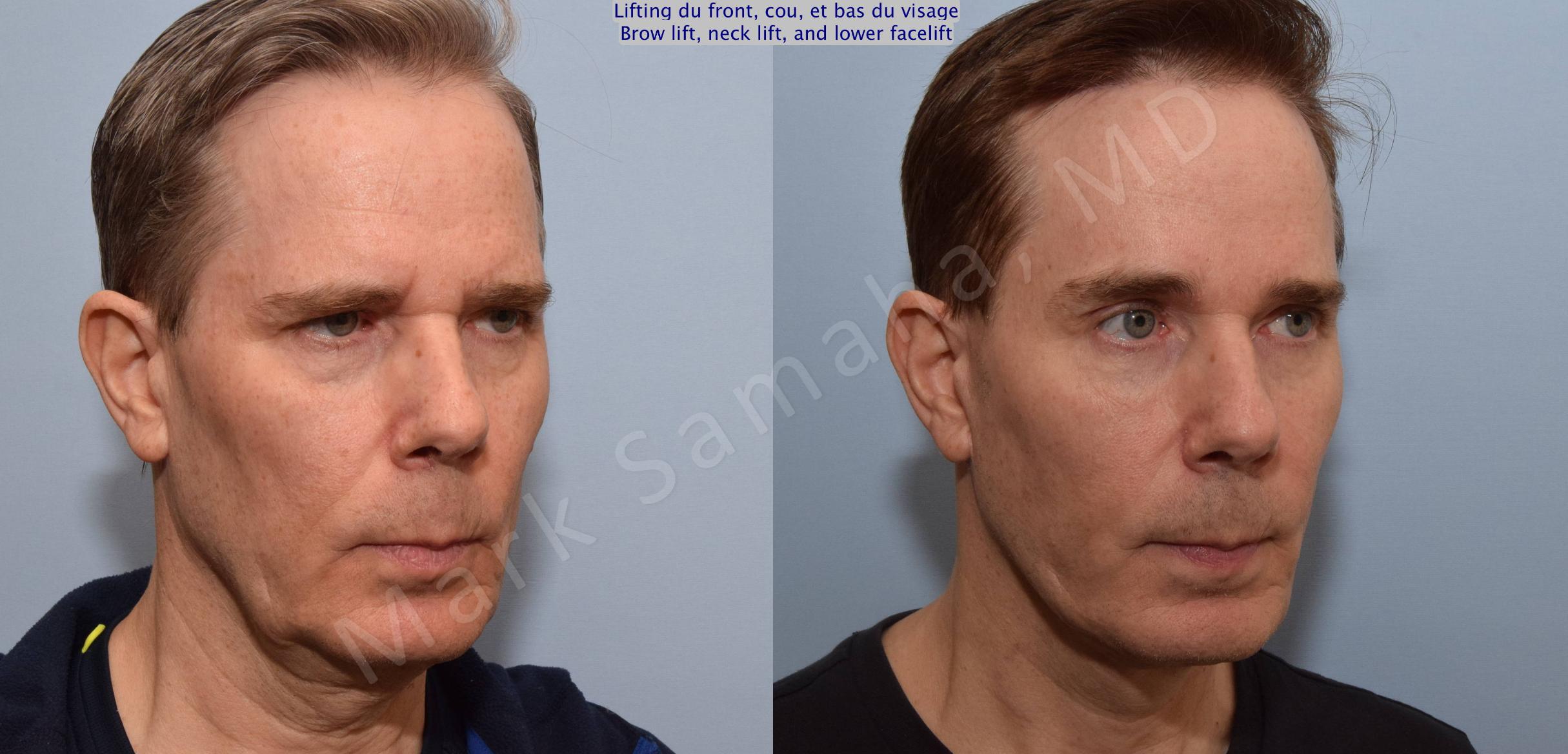 Before & After Lifting du Sourcil / Brow lift Case 91 View #5 View in Mount Royal, QC