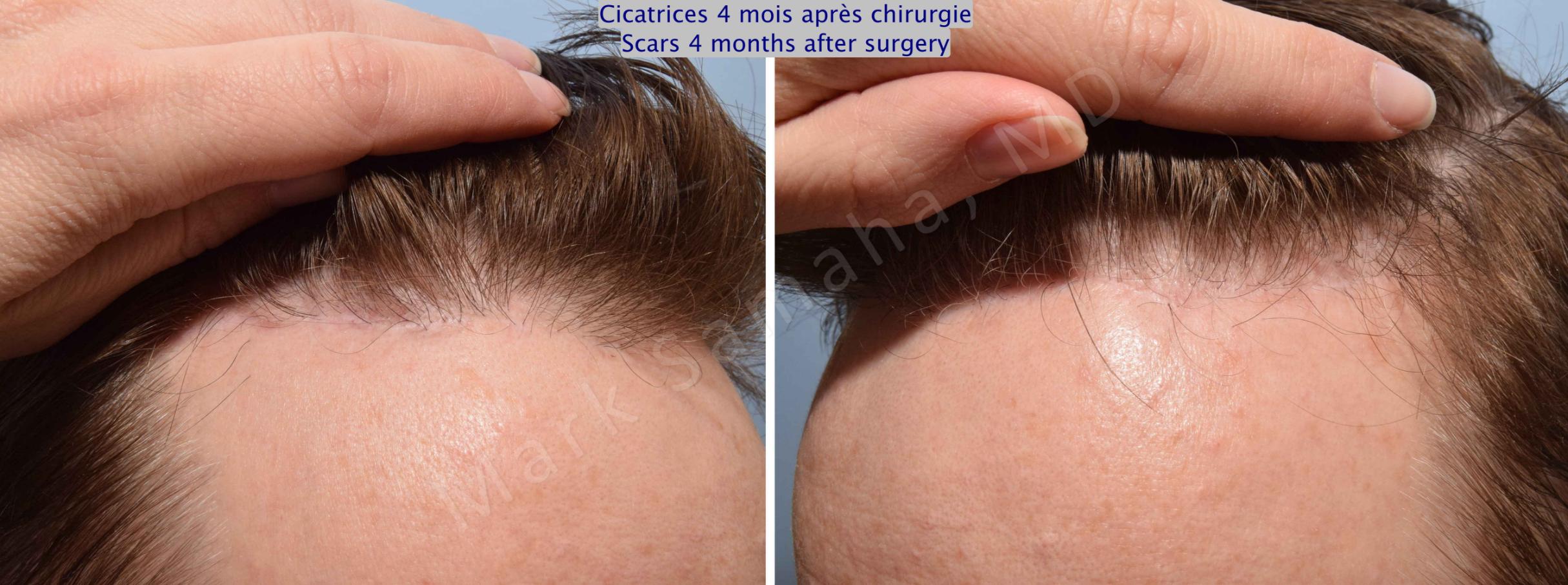 Before & After Lifting du Sourcil / Brow lift Case 91 View #6 View in Mount Royal, QC
