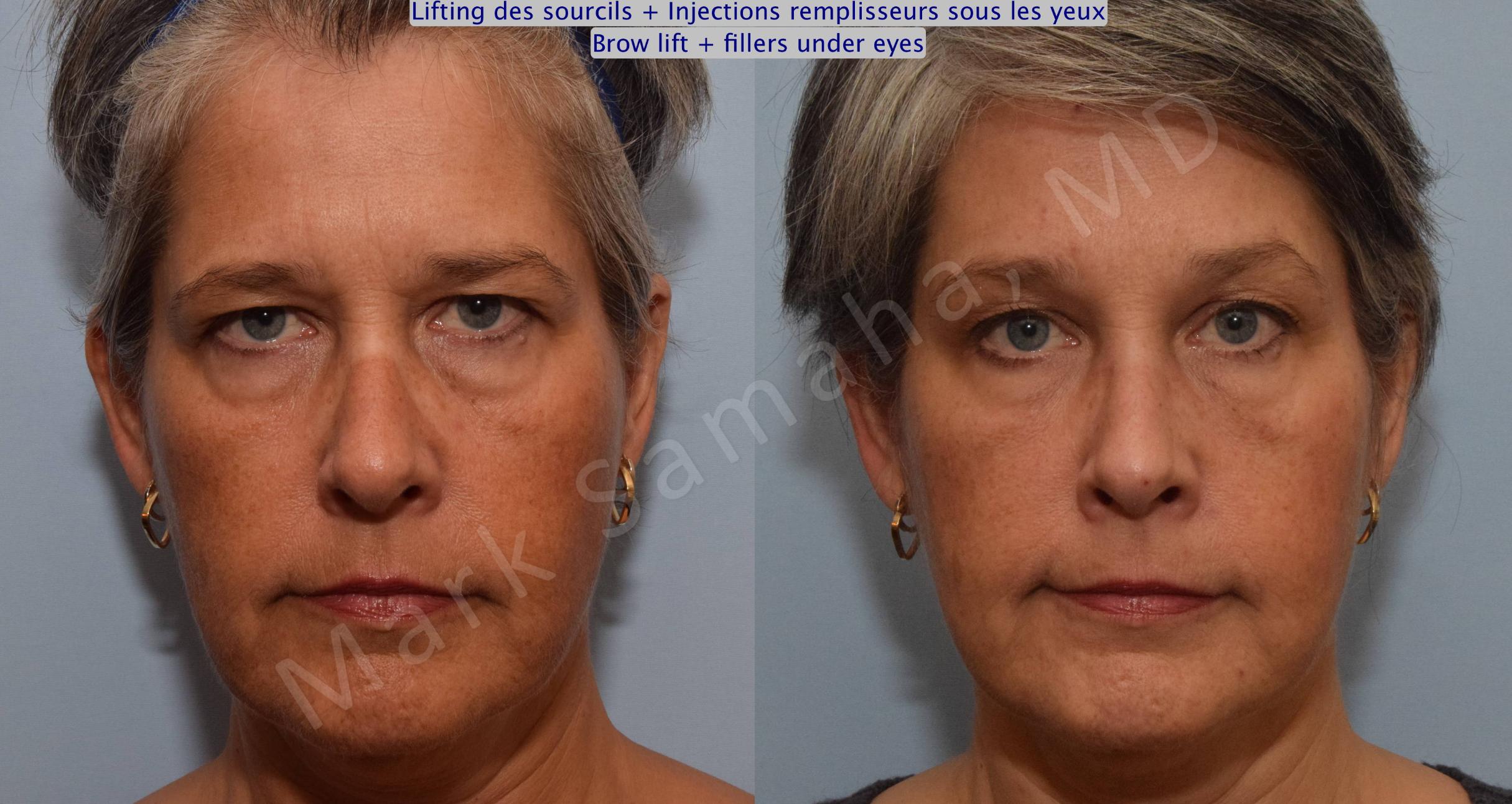 Before & After Brow lift / Lifting du Sourcil Case 97 View #1 View in Mount Royal, QC