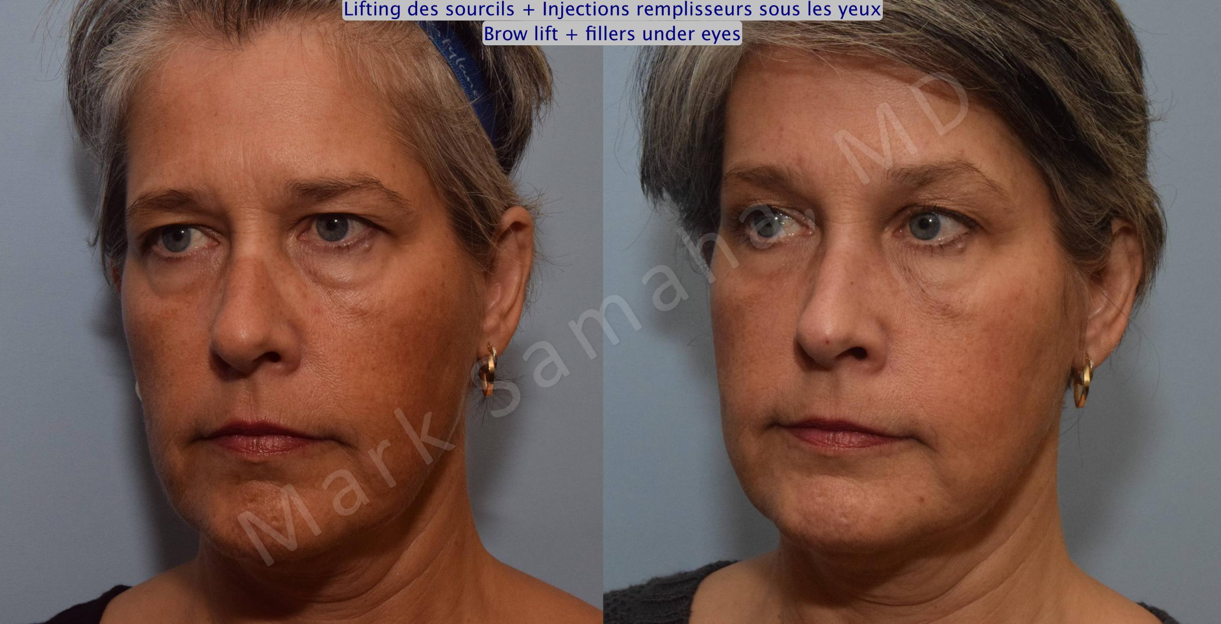 Before & After Lifting du Sourcil / Brow lift Case 97 View #2 View in Mount Royal, QC