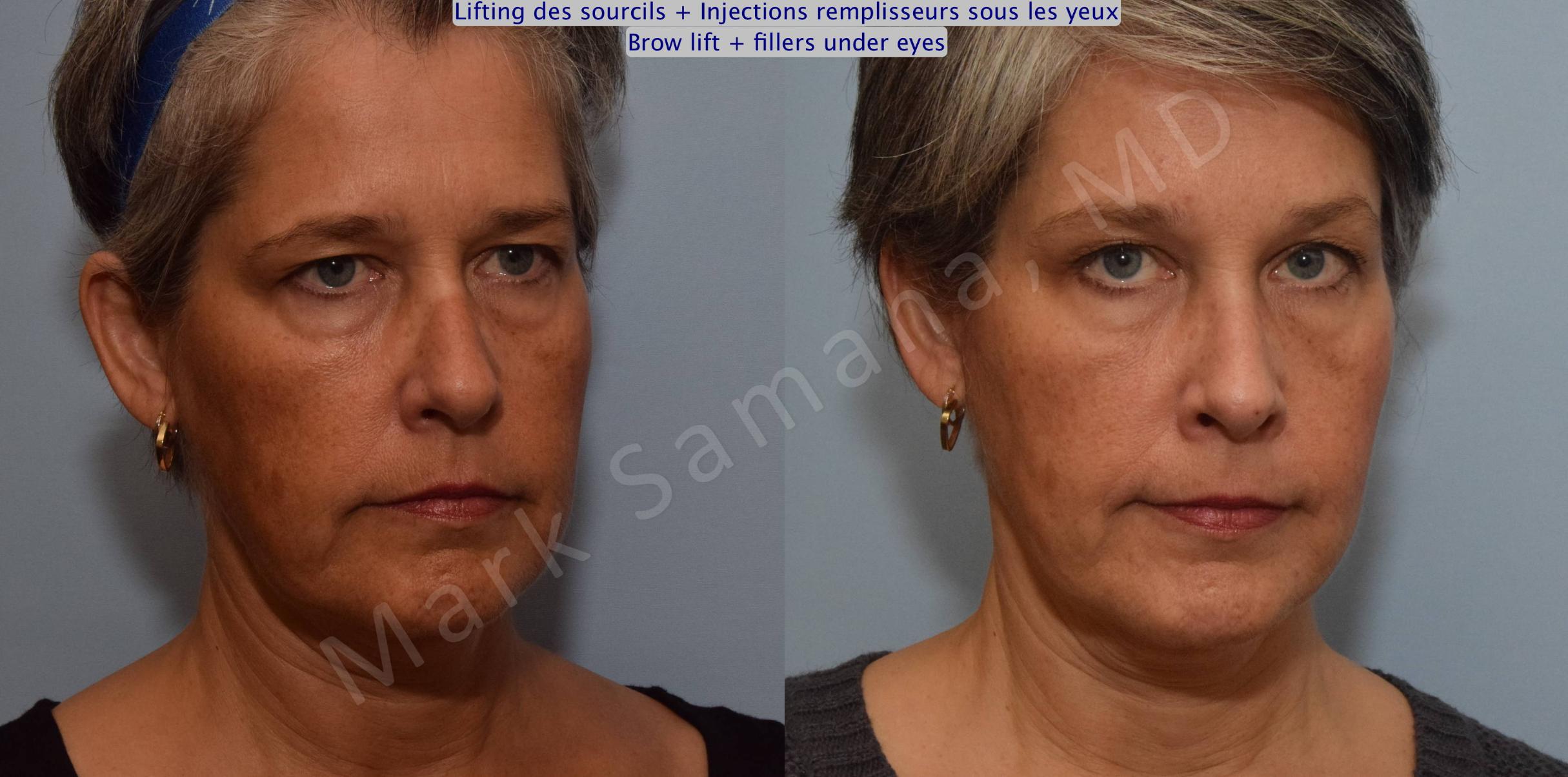 Before & After Brow lift / Lifting du Sourcil Case 97 View #3 View in Mount Royal, QC