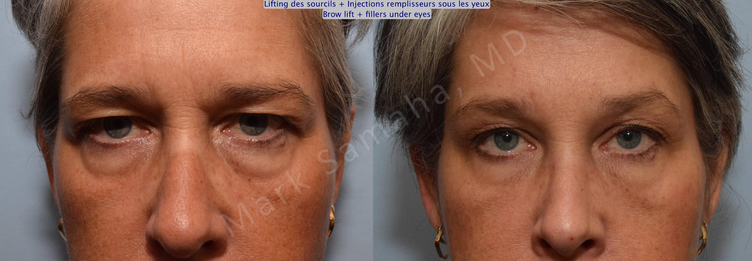Before & After Brow lift / Lifting du Sourcil Case 97 View #4 View in Mount Royal, QC