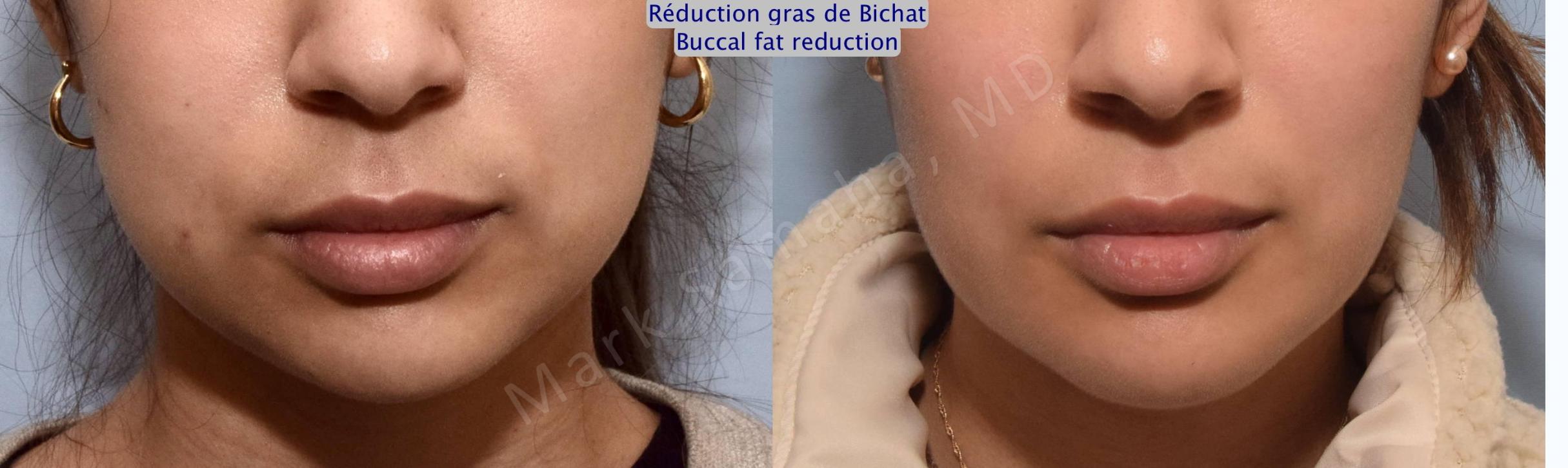 Before & After Réduction des Boules de Bichat / Buccal Fat Removal Case 157 Front View in Mount Royal, QC