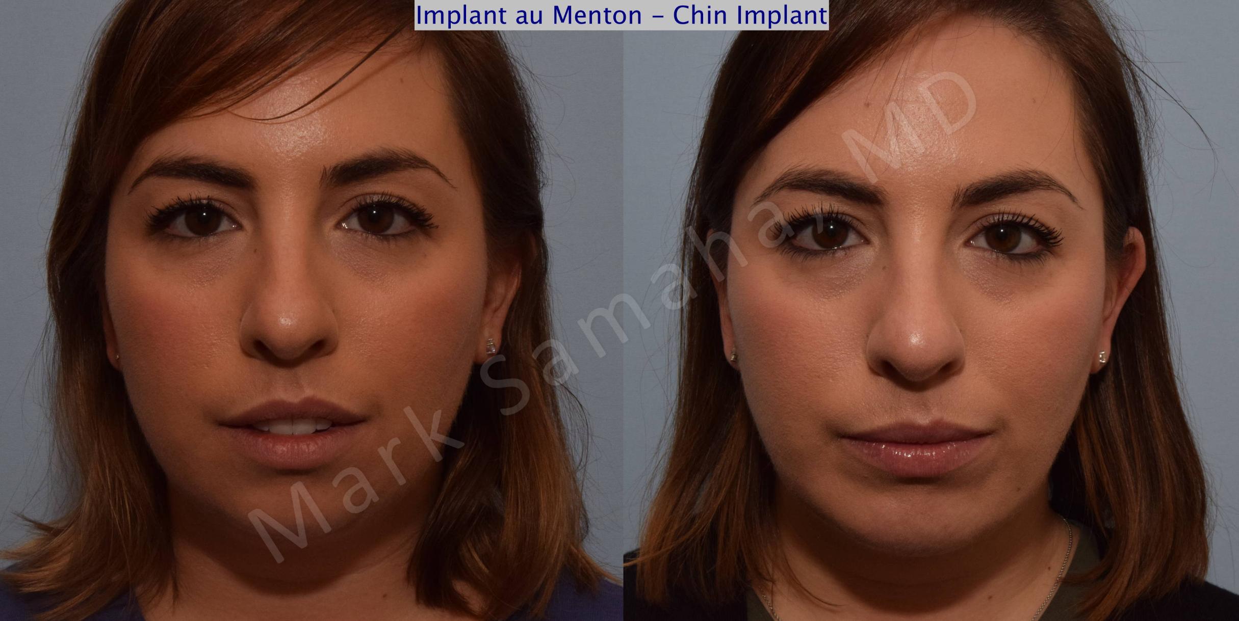 Before & After Chin Augmentation / Augmentation du menton Case 104 View #3 View in Mount Royal, QC