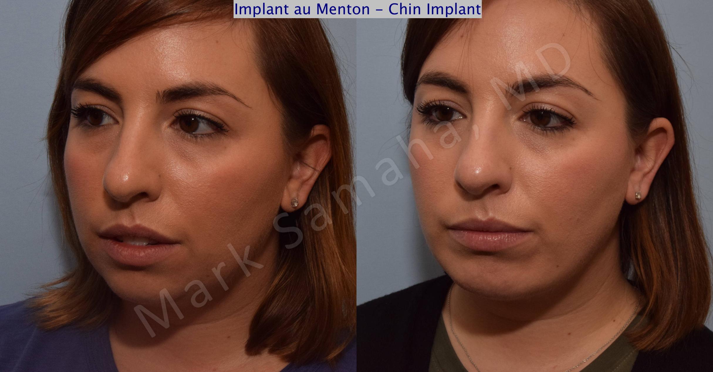 Before & After Chin Augmentation / Augmentation du menton Case 104 View #4 View in Mount Royal, QC
