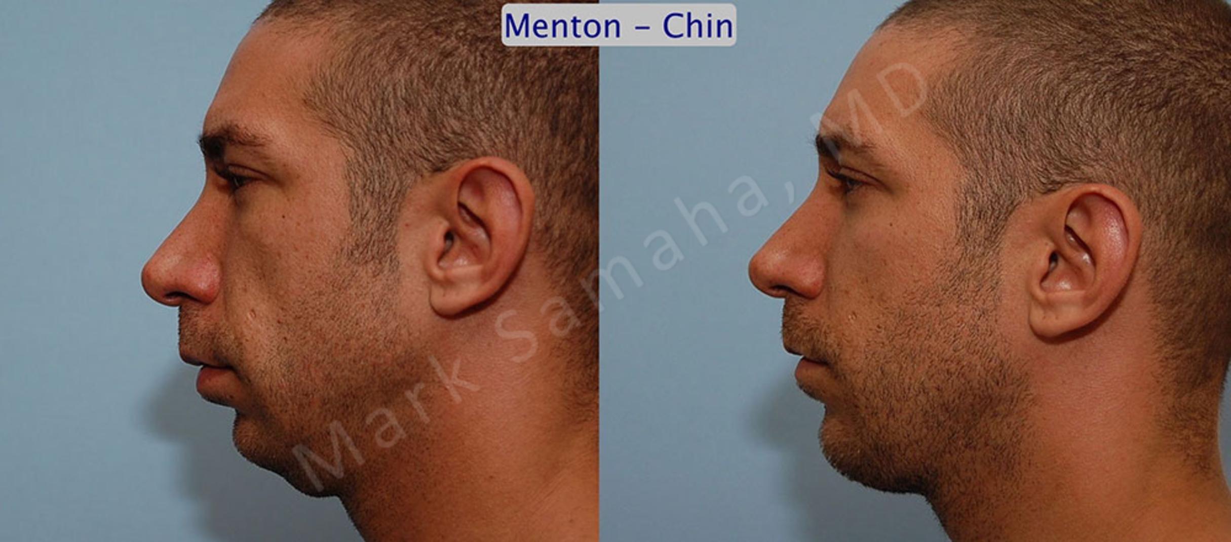 Before & After Chin Augmentation / Augmentation du menton Case 11 View #1 View in Mount Royal, QC