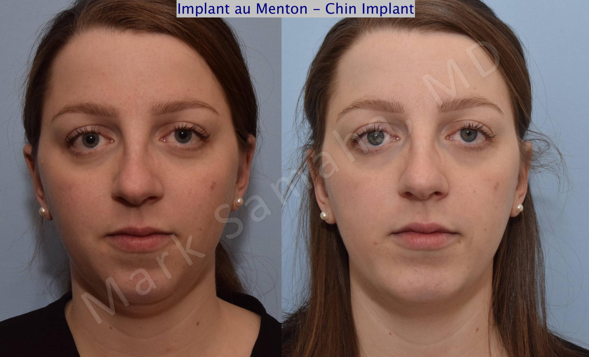 Before & After Chin Augmentation / Augmentation du menton Case 111 View #2 View in Mount Royal, QC
