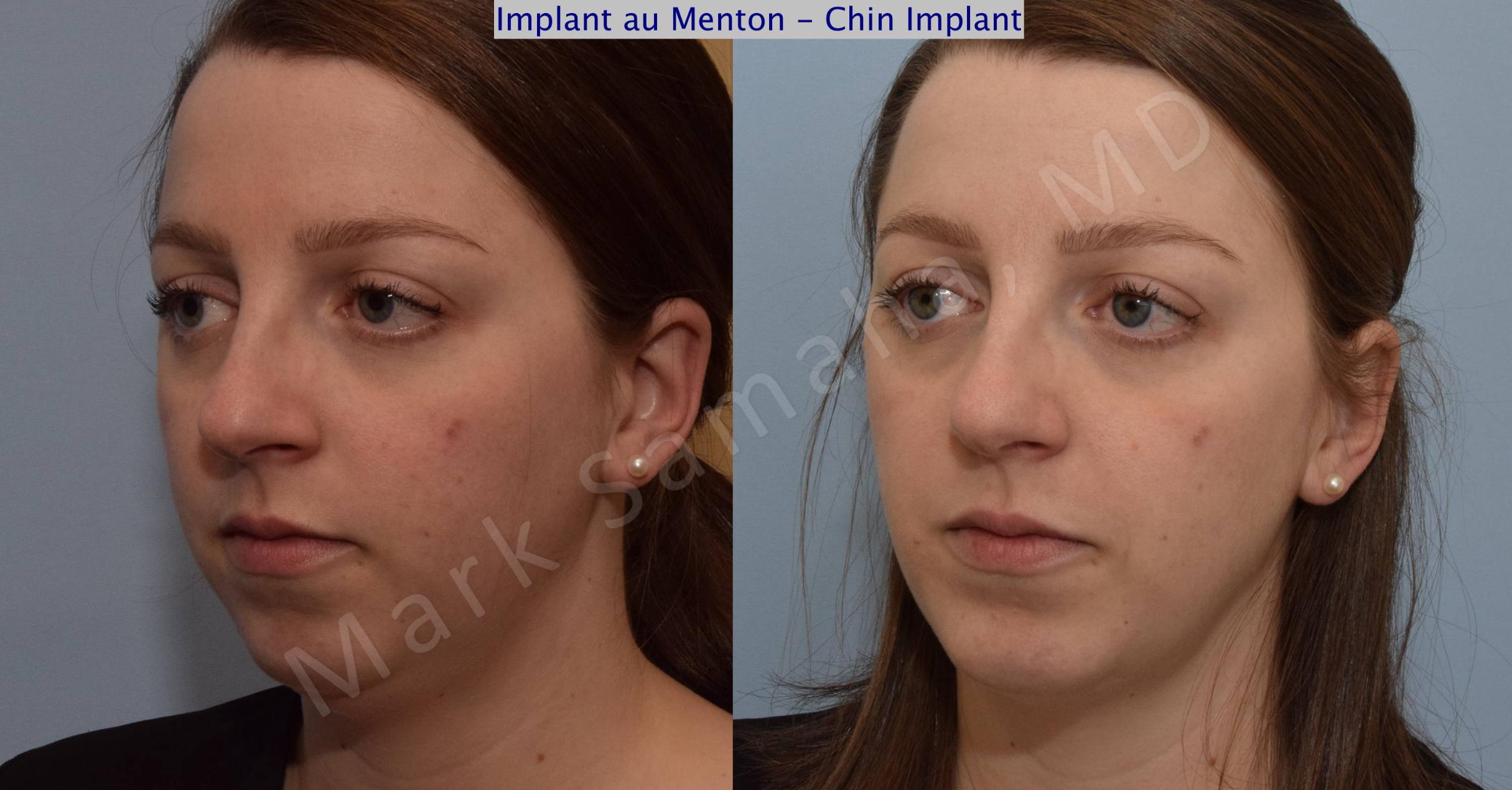 Before & After Chin Augmentation / Augmentation du menton Case 111 View #4 View in Mount Royal, QC