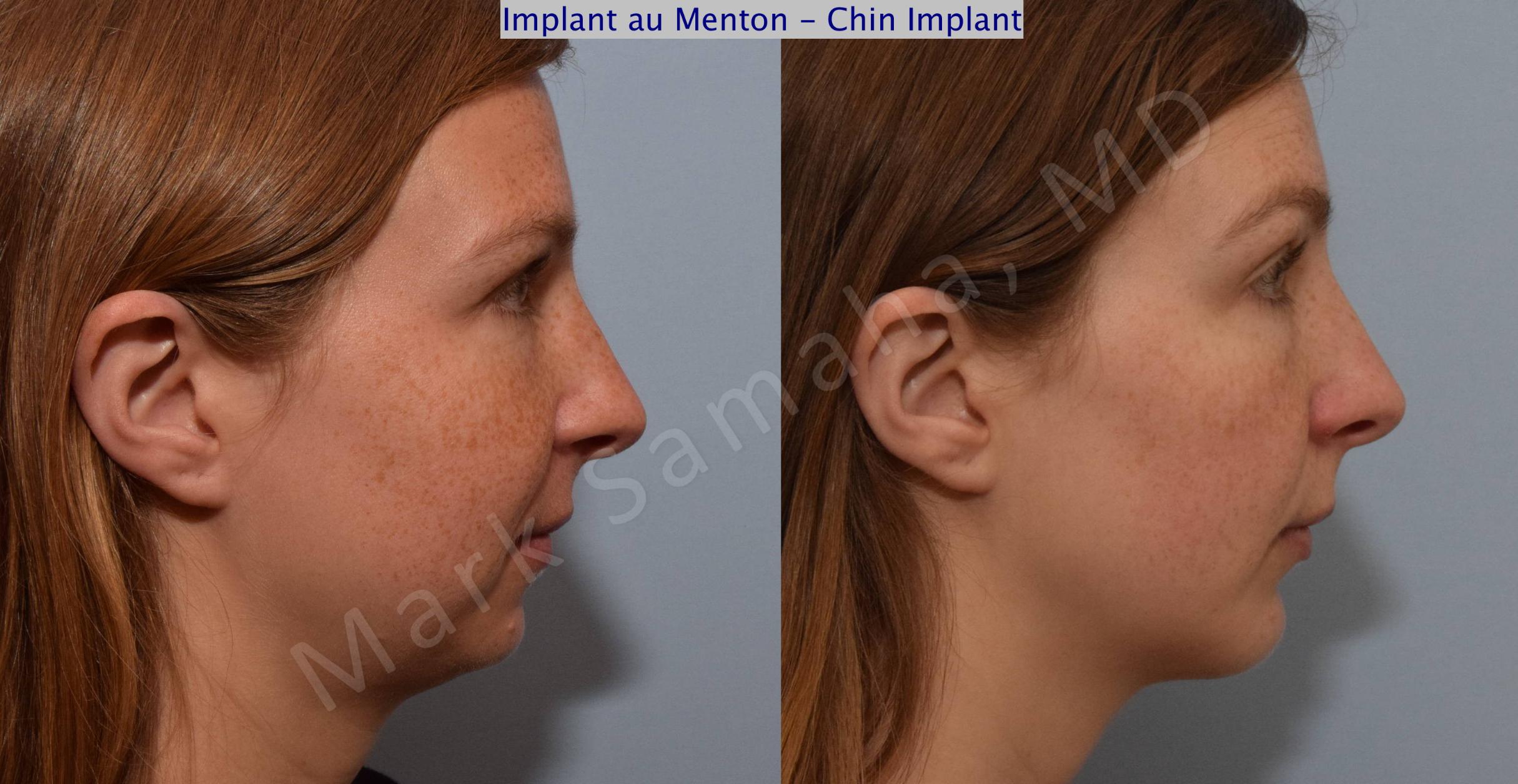 Before & After Chin Augmentation / Augmentation du menton Case 112 View #1 View in Mount Royal, QC
