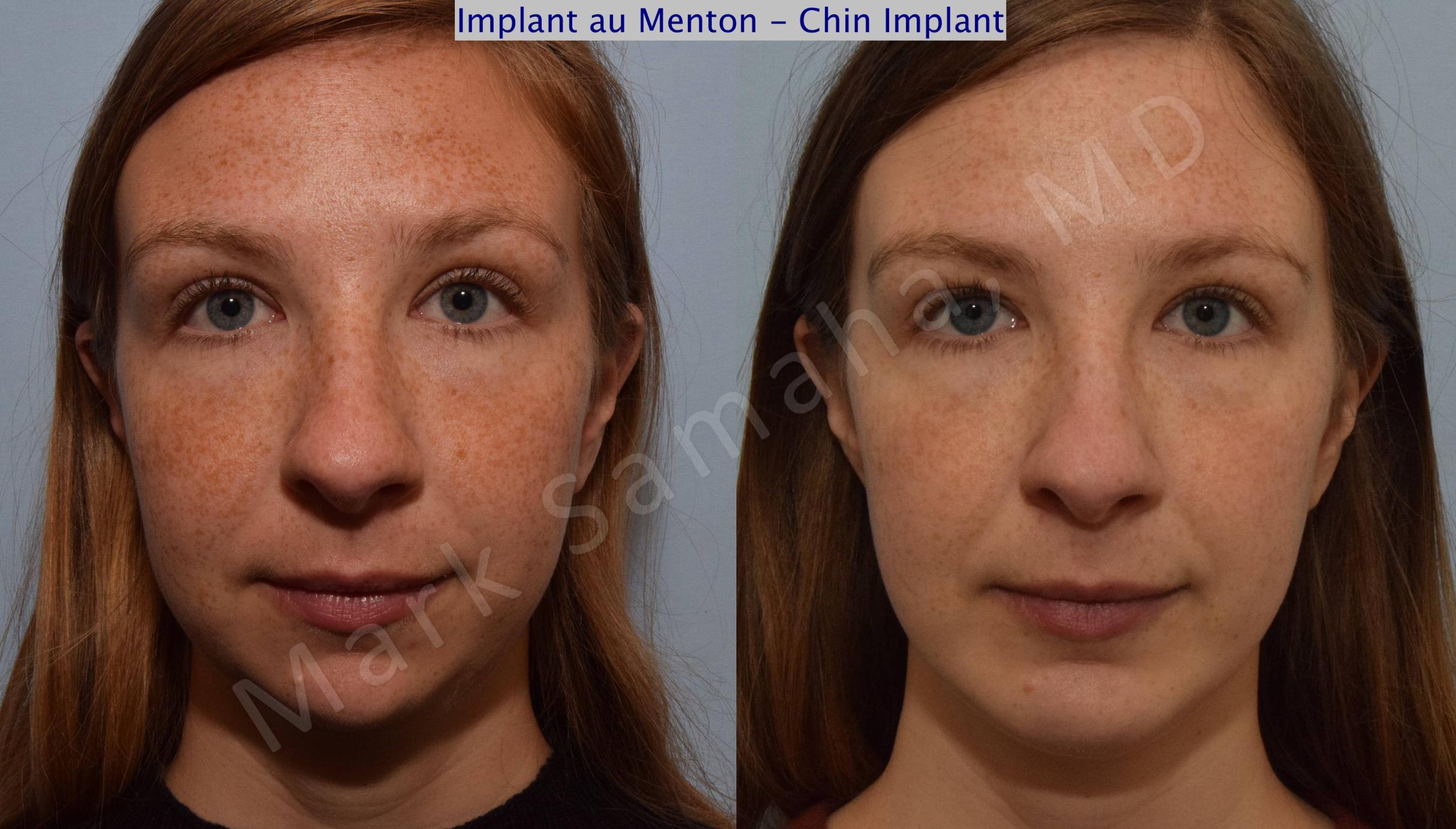 Before & After Chin Augmentation / Augmentation du menton Case 112 View #2 View in Mount Royal, QC