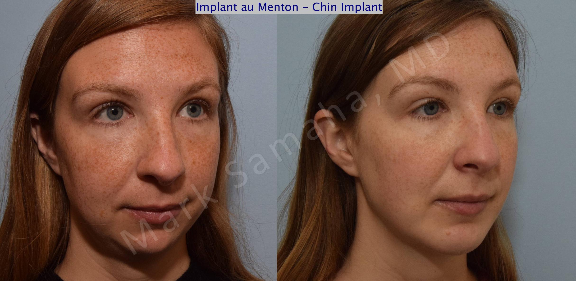 Before & After Chin Augmentation / Augmentation du menton Case 112 View #5 View in Mount Royal, QC