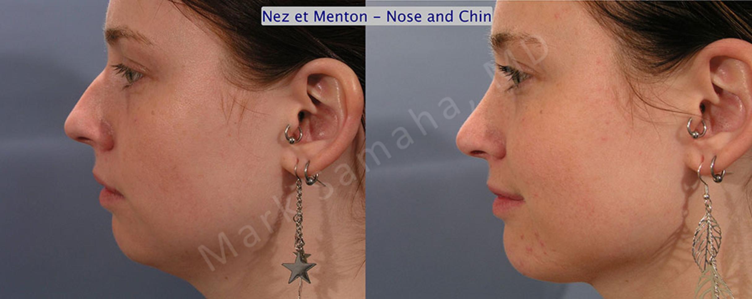 Before & After Augmentation du menton / Chin Augmentation Case 12 View #1 View in Mount Royal, QC