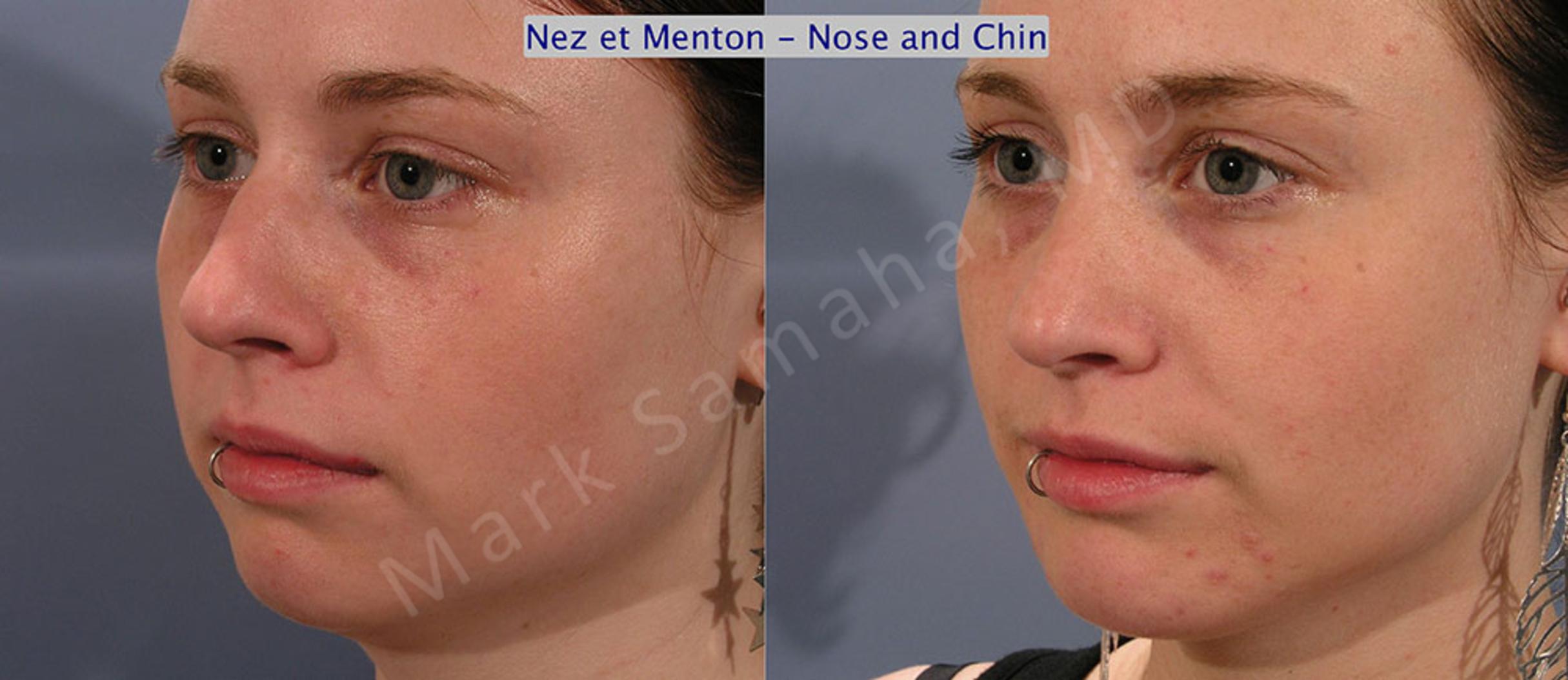 Before & After Chin Augmentation / Augmentation du menton Case 12 View #2 View in Mount Royal, QC