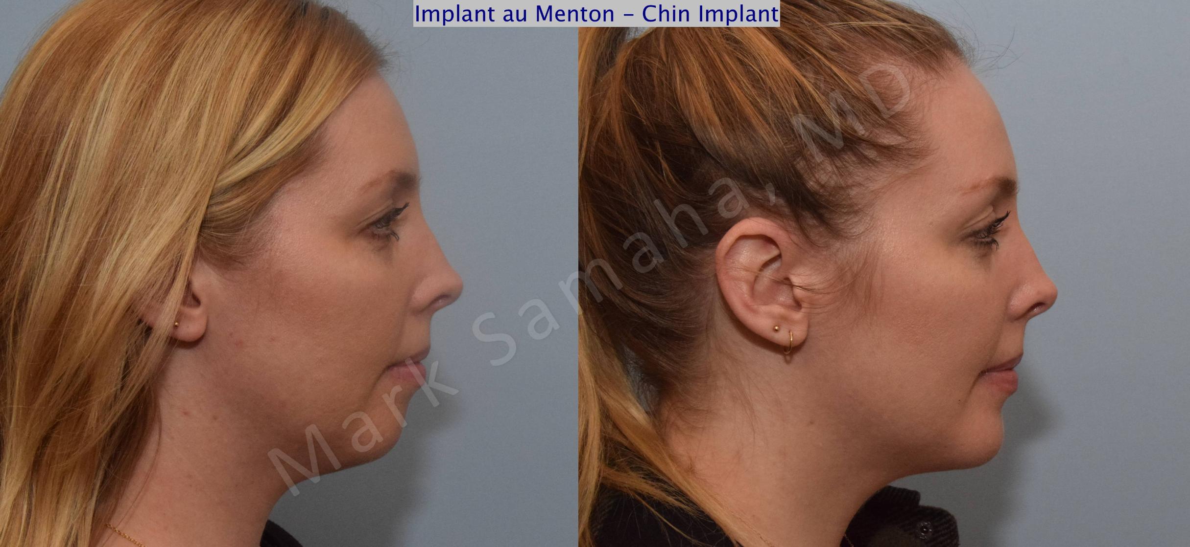 Before & After Chin Augmentation / Augmentation du menton Case 120 View #2 View in Mount Royal, QC