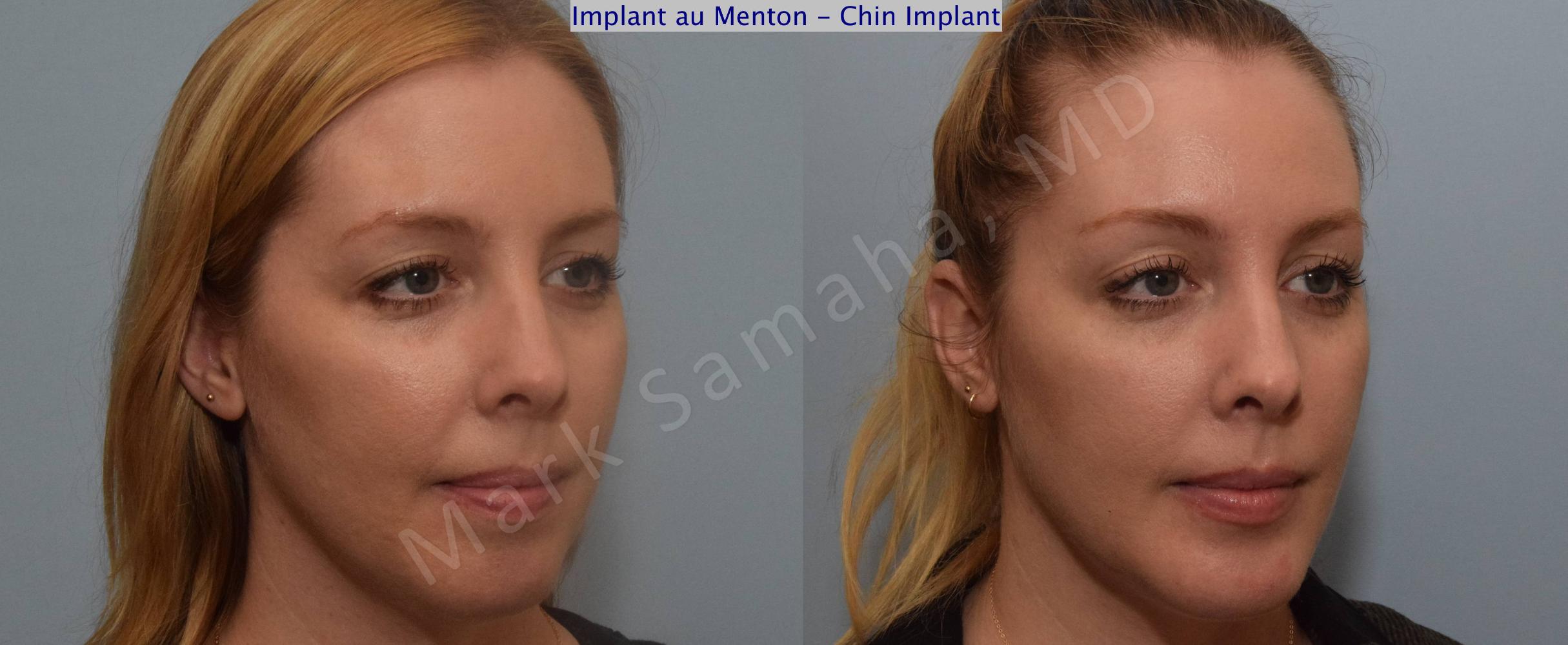 Before & After Chin Augmentation / Augmentation du menton Case 120 View #4 View in Mount Royal, QC