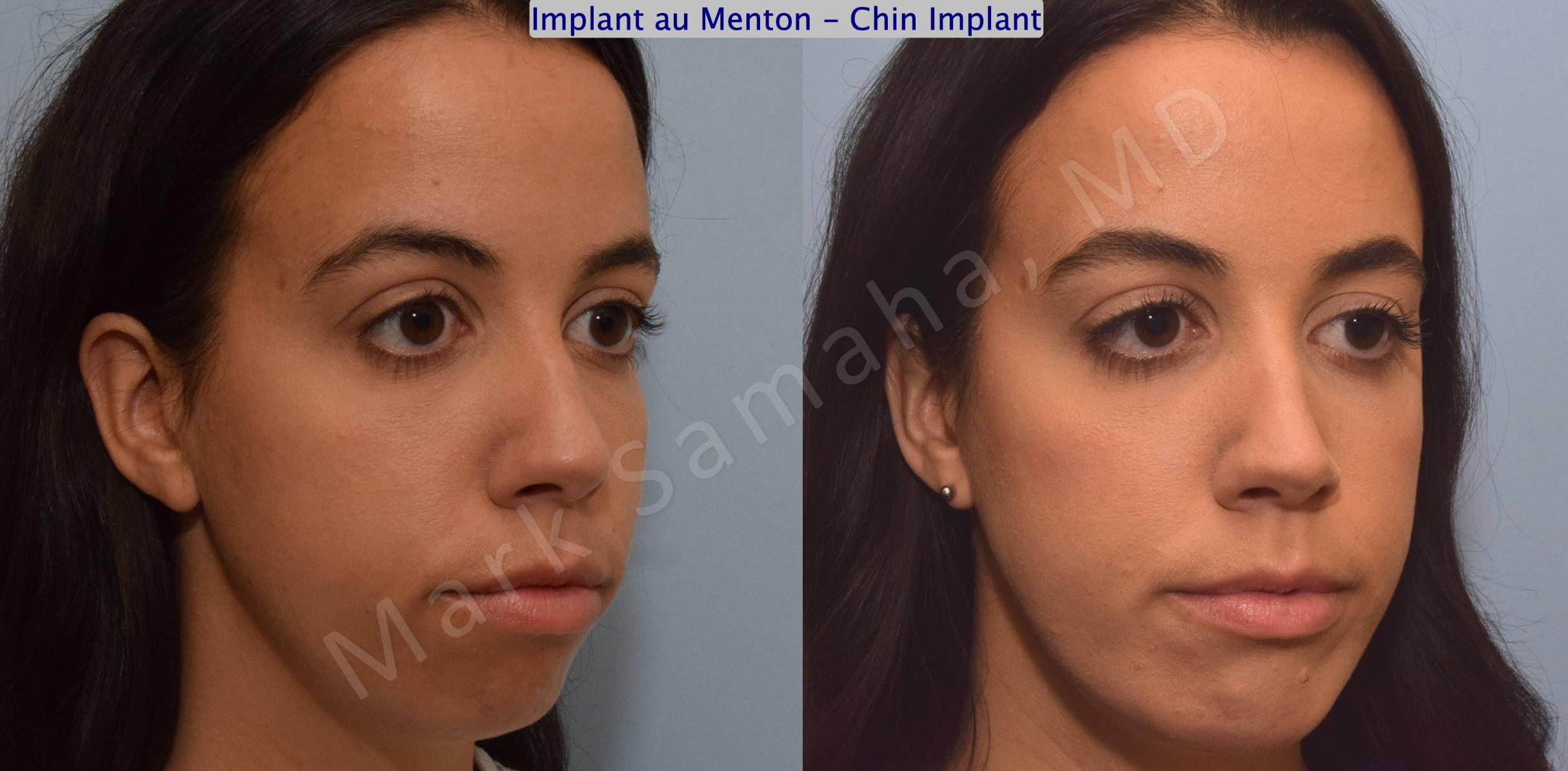 Before & After Chin Augmentation / Augmentation du menton Case 121 View #5 View in Mount Royal, QC