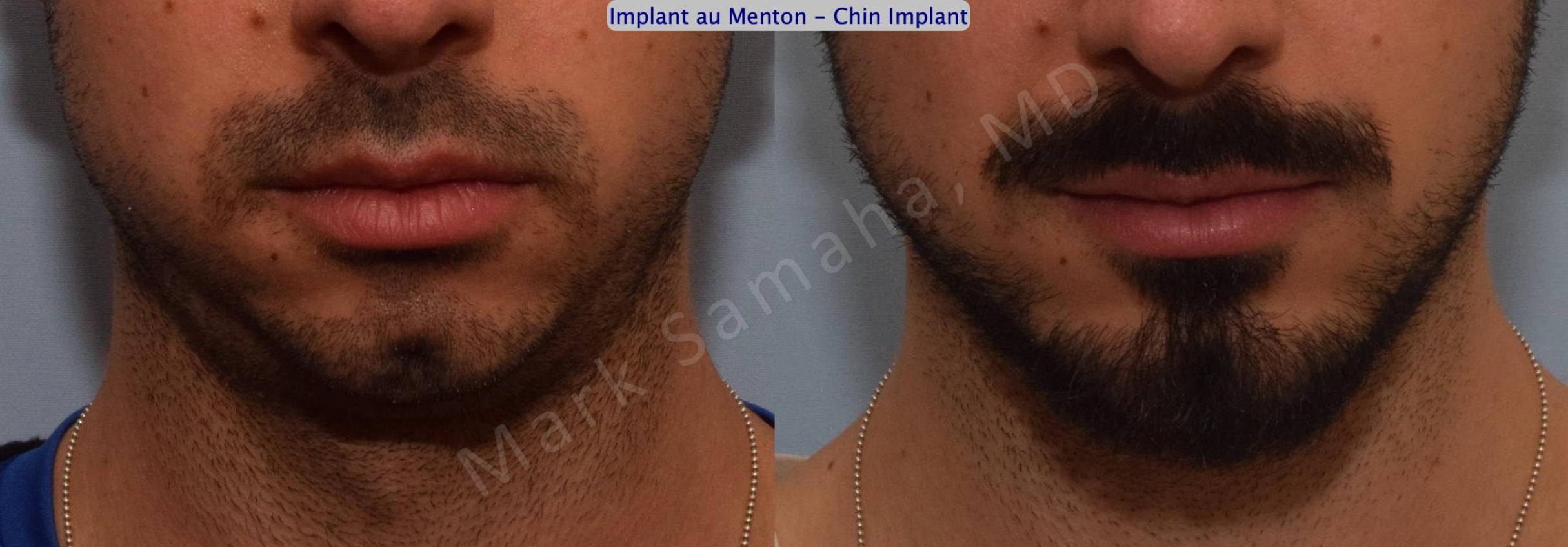 Before & After Chin Augmentation / Augmentation du menton Case 126 View #2 View in Mount Royal, QC