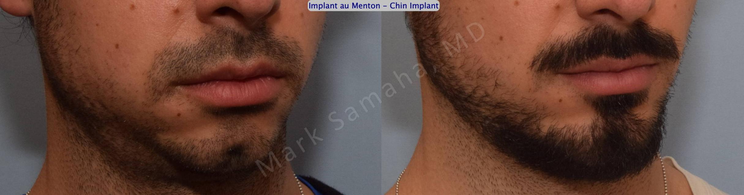 Before & After Chin Augmentation / Augmentation du menton Case 126 View #5 View in Mount Royal, QC
