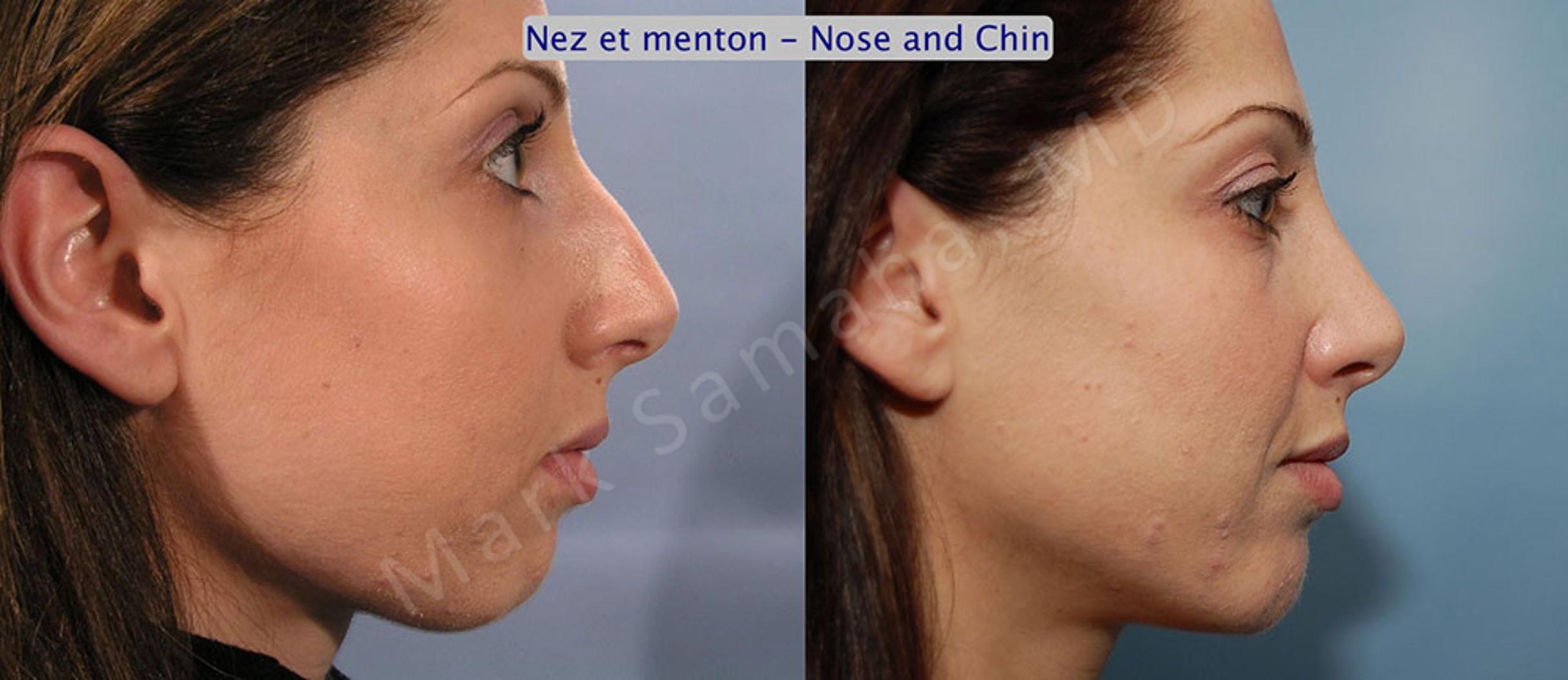 Before & After Chin Augmentation / Augmentation du menton Case 13 View #1 View in Mount Royal, QC