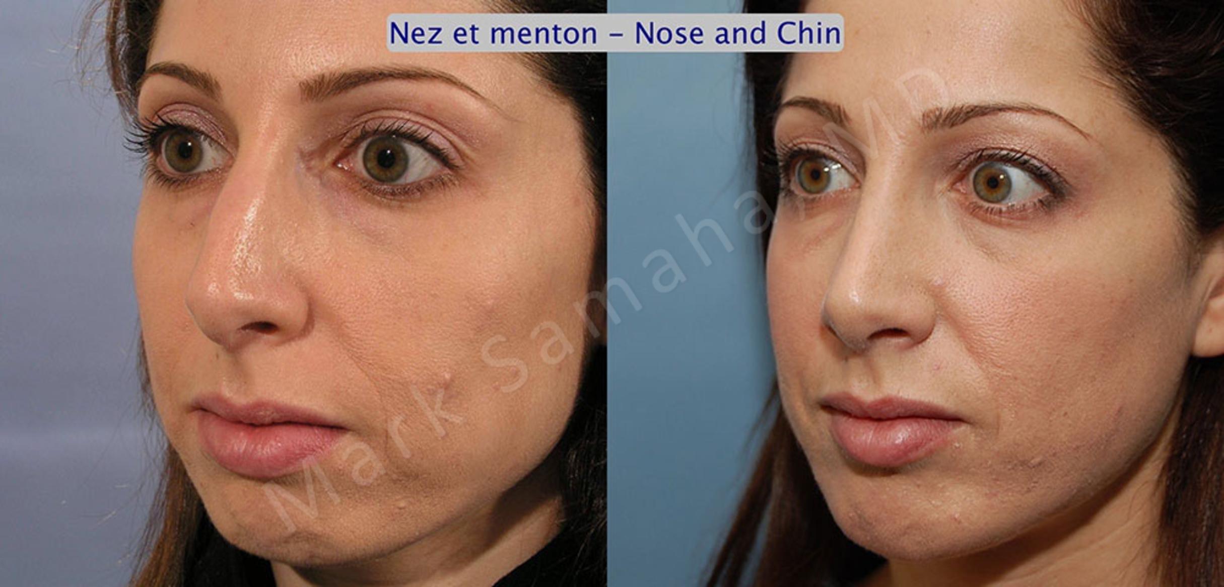 Before & After Chin Augmentation / Augmentation du menton Case 13 View #2 View in Mount Royal, QC