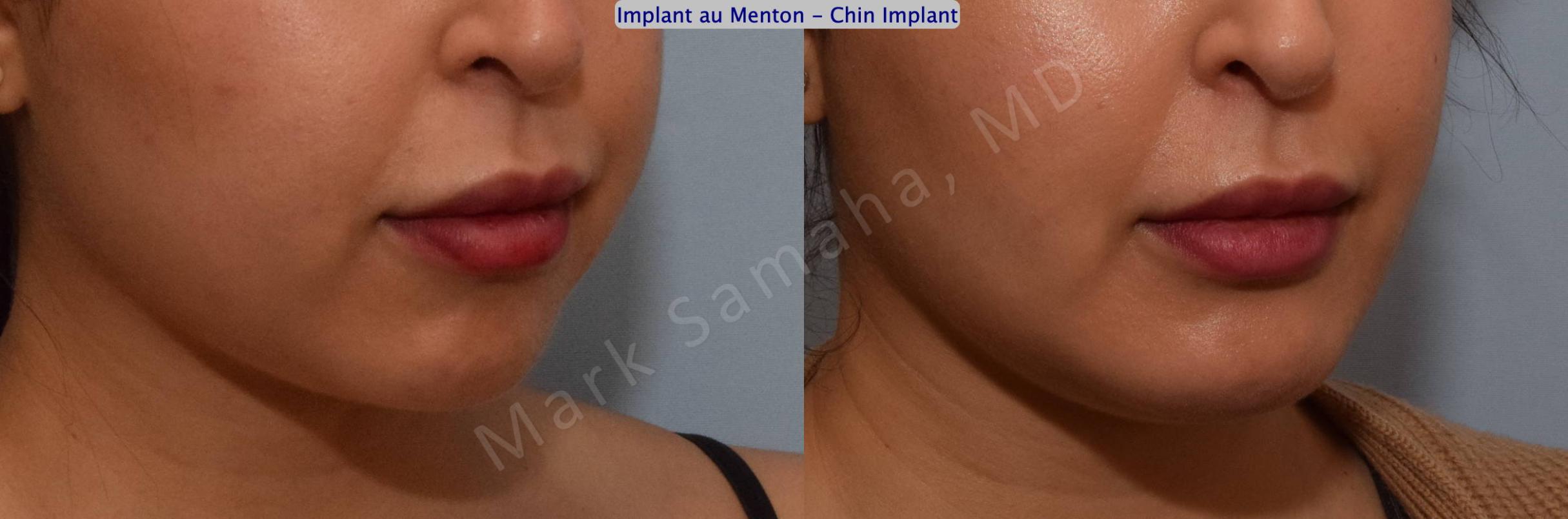 Before & After Chin Augmentation / Augmentation du menton Case 133 View #1 View in Mount Royal, QC