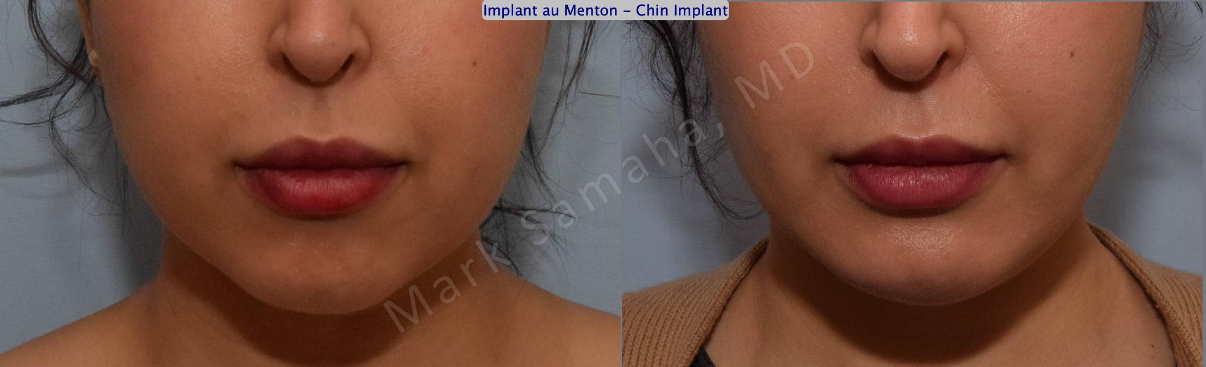 Before & After Chin Augmentation / Augmentation du menton Case 133 View #2 View in Mount Royal, QC