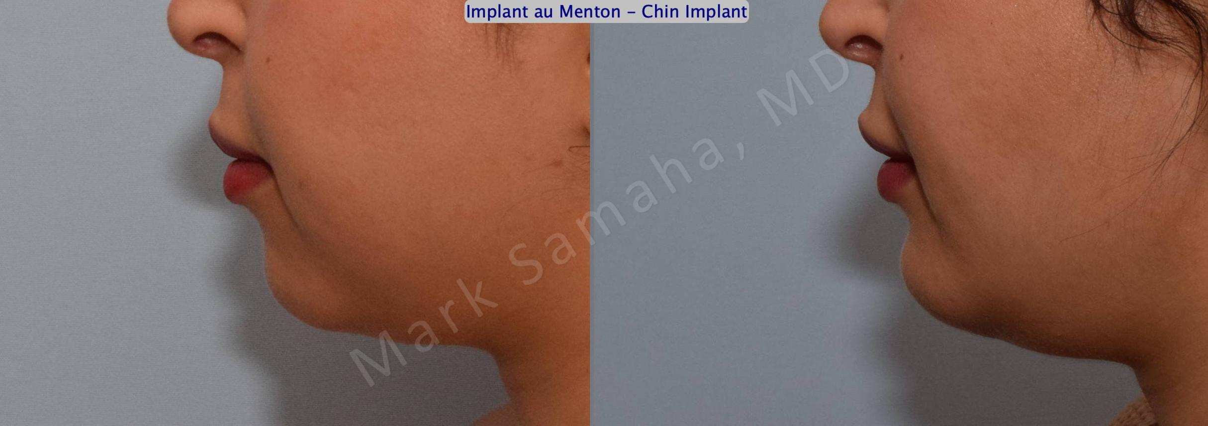 Before & After Chin Augmentation / Augmentation du menton Case 133 View #3 View in Mount Royal, QC