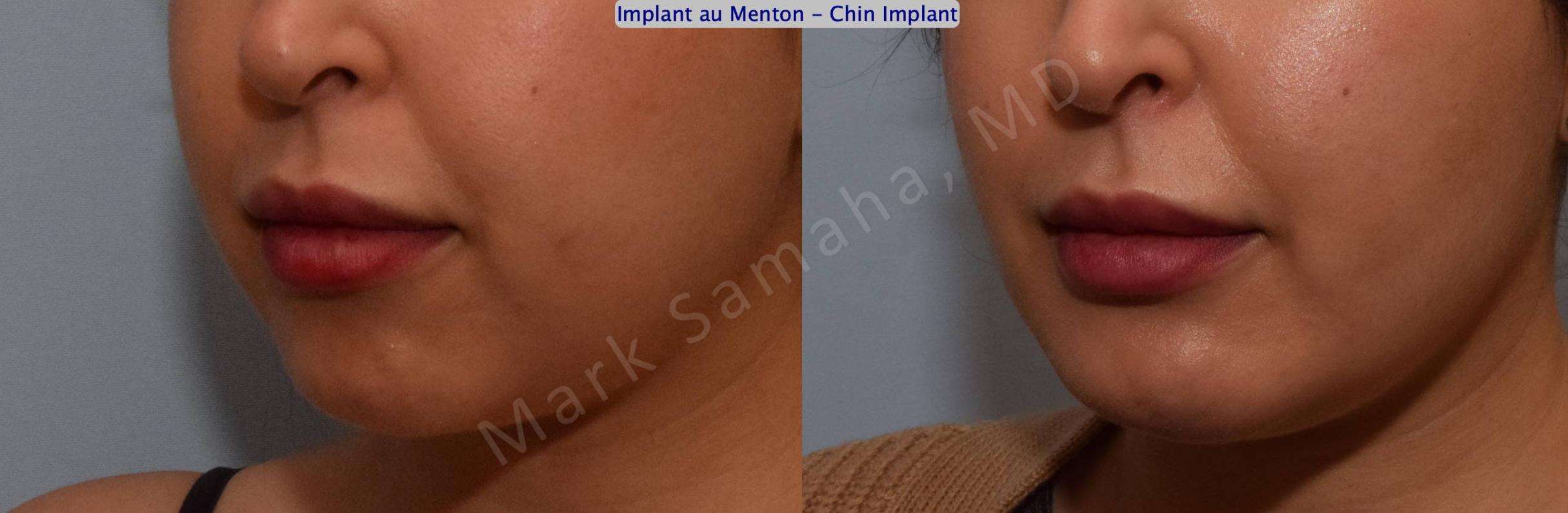 Before & After Chin Augmentation / Augmentation du menton Case 133 View #5 View in Mount Royal, QC