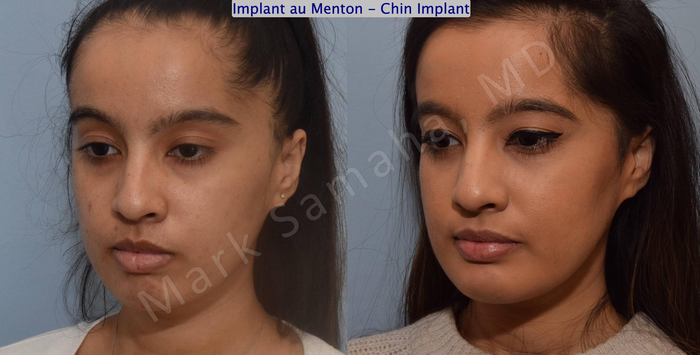 Before & After Chin Augmentation / Augmentation du menton Case 134 View #4 View in Mount Royal, QC