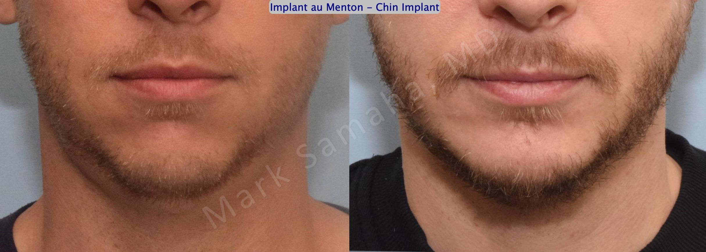 Before & After Chin Augmentation / Augmentation du menton Case 135 View #2 View in Mount Royal, QC