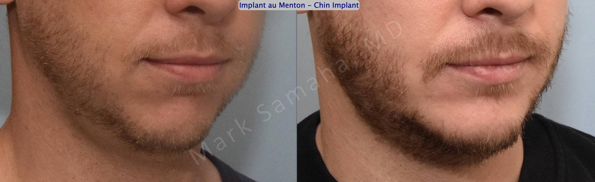 Before & After Augmentation du menton / Chin Augmentation Case 135 View #5 View in Mount Royal, QC
