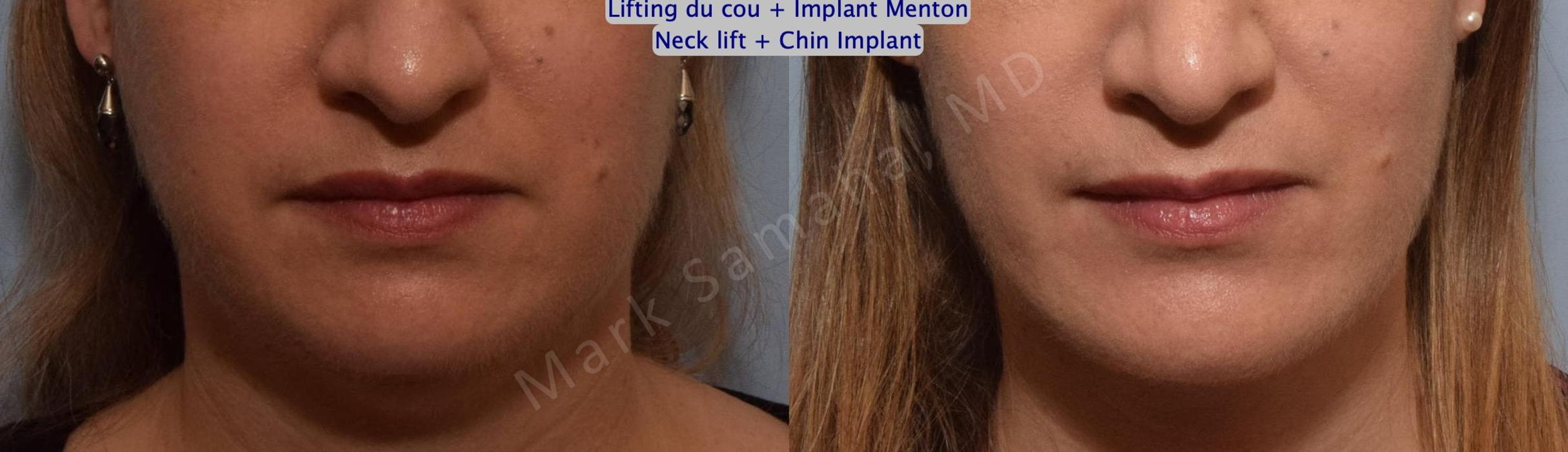 Before & After Chin Augmentation / Augmentation du menton Case 147 Front View in Mount Royal, QC