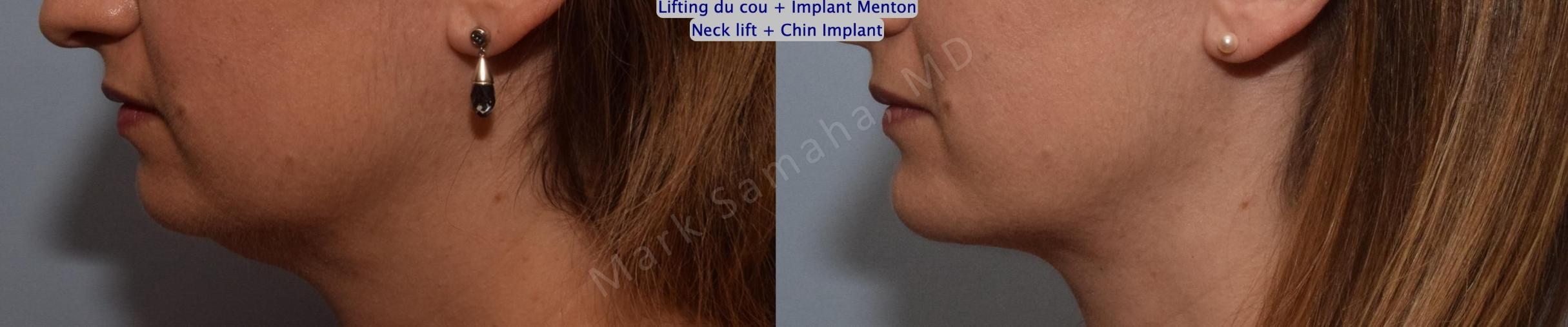 Before & After Augmentation du menton / Chin Augmentation Case 147 Left Side View in Mount Royal, QC