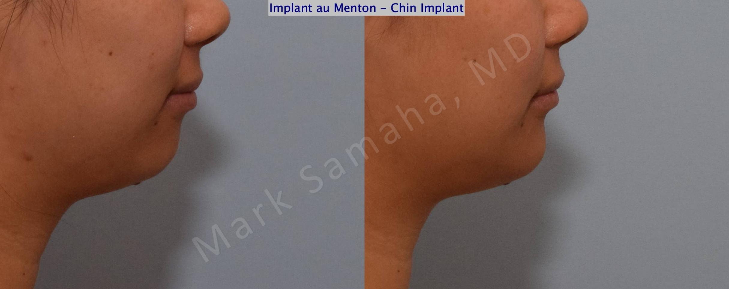 Before & After Chin Augmentation / Augmentation du menton Case 148 Right Side View in Mount Royal, QC