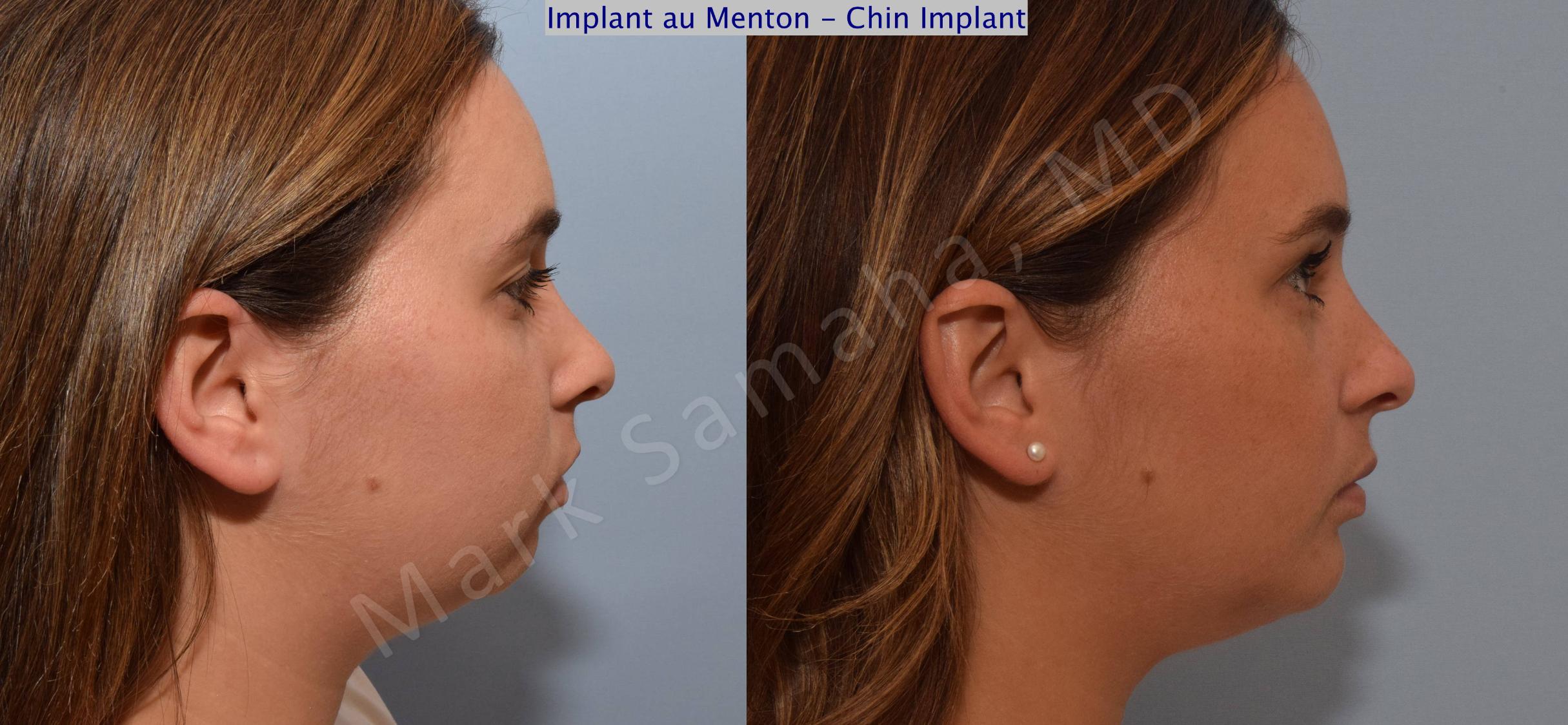 Before & After Augmentation du menton / Chin Augmentation Case 98 View #1 View in Mount Royal, QC