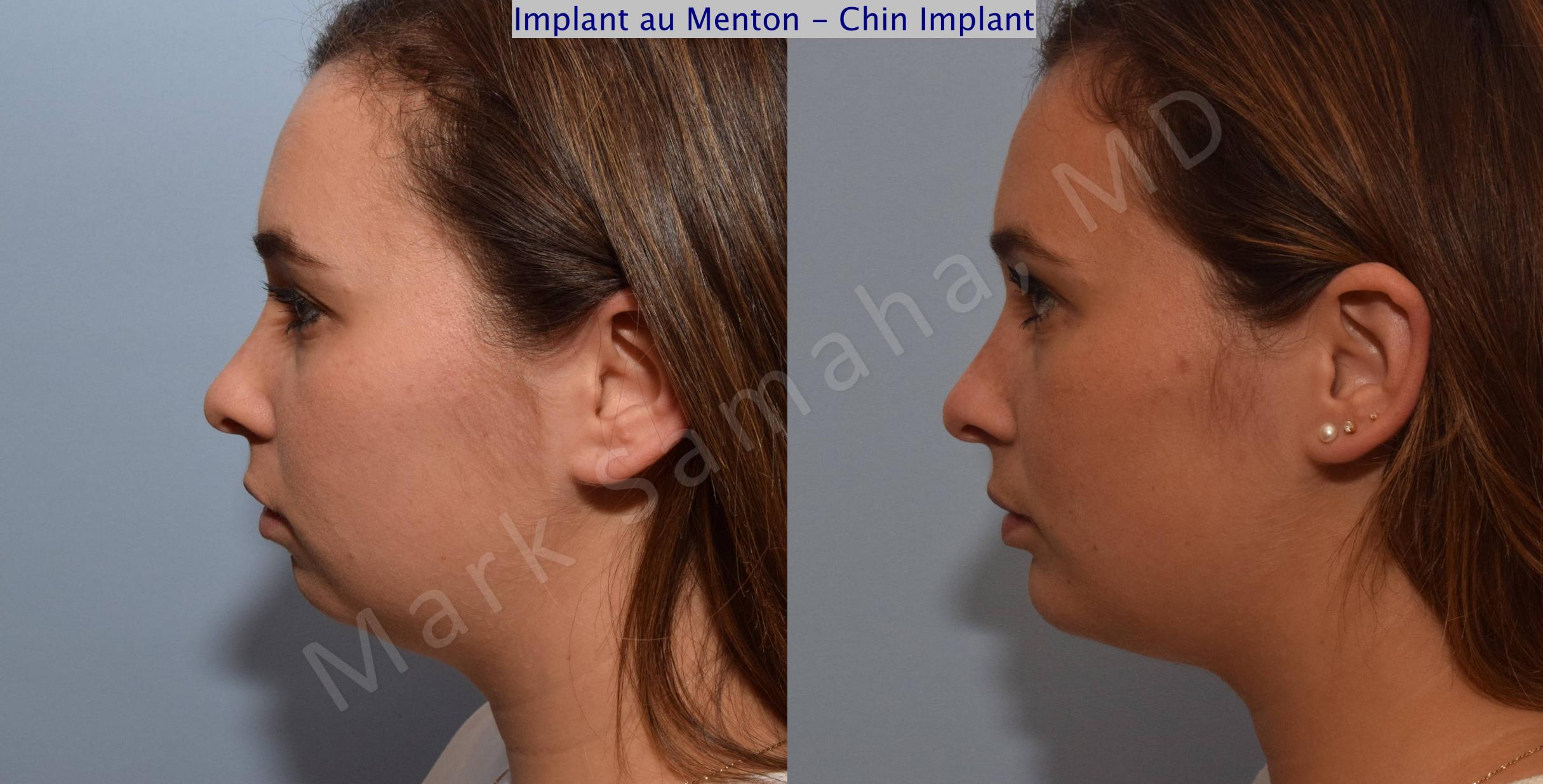 Before & After Chin Augmentation / Augmentation du menton Case 98 View #3 View in Mount Royal, QC