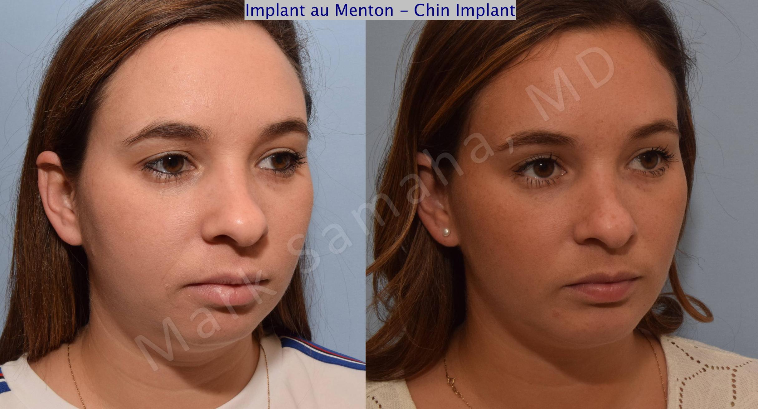 Before & After Chin Augmentation / Augmentation du menton Case 98 View #5 View in Mount Royal, QC