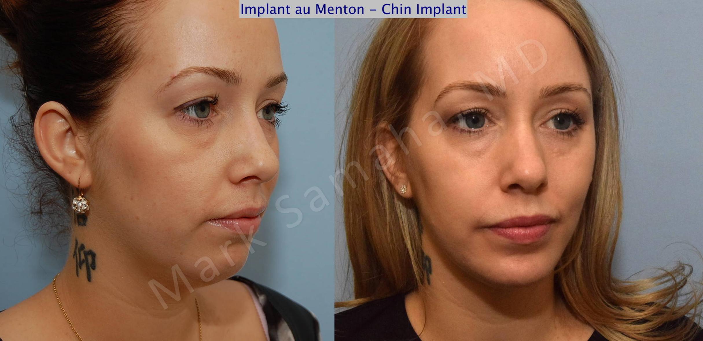 Before & After Chin Augmentation / Augmentation du menton Case 99 View #5 View in Mount Royal, QC