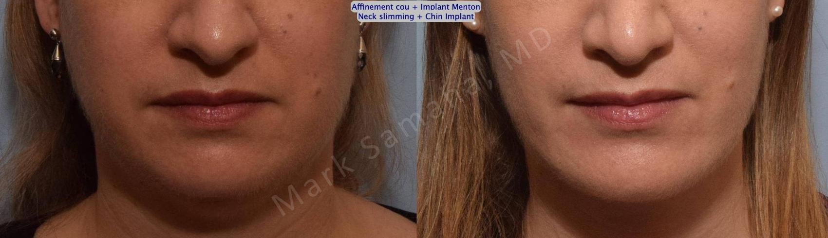 Before & After Chirurgie d'affinement du visage / Face slimming-Face contouring Case 161 Front View in Mount Royal, QC