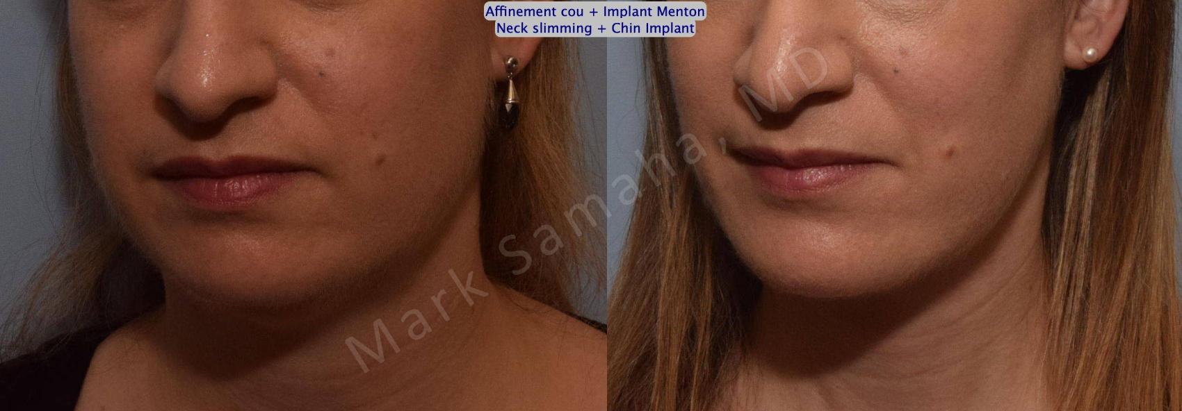Before & After Chirurgie d'affinement du visage / Face slimming-Face contouring Case 161 Left Oblique View in Mount Royal, QC