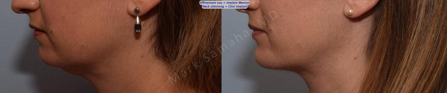 Before & After Chirurgie d'affinement du visage / Face slimming-Face contouring Case 161 Left Side View in Mount Royal, QC