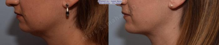 Before & After Chirurgie d’affinement du visage / Face Slimming Surgery Case 161 Left Side View in Montreal, QC