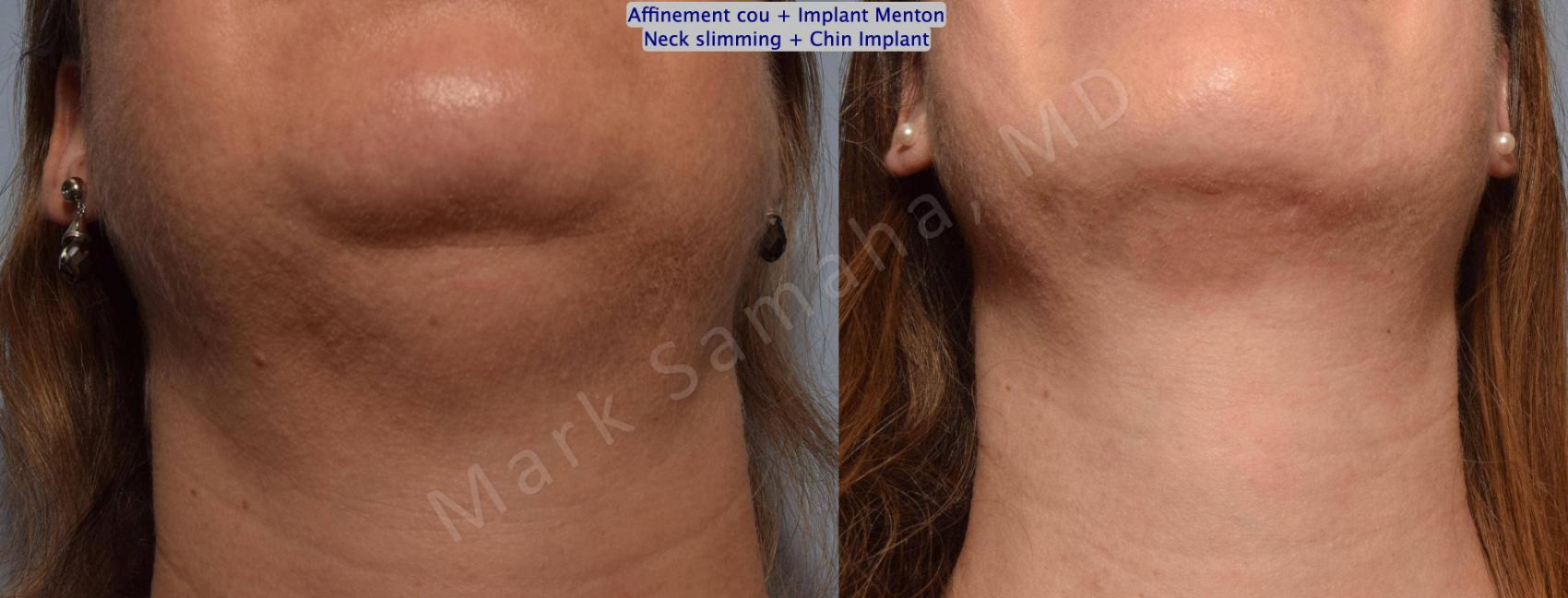 Before & After Chirurgie d'affinement du visage / Face slimming-Face contouring Case 161 Neck / Cou View in Mount Royal, QC